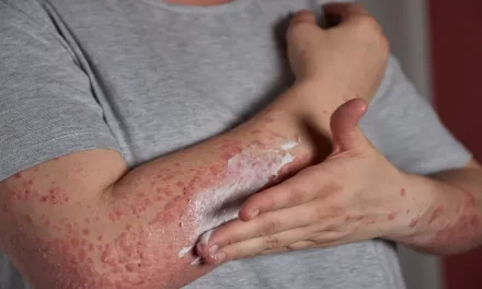 ¿Cuándo es contagiosa la varicela?